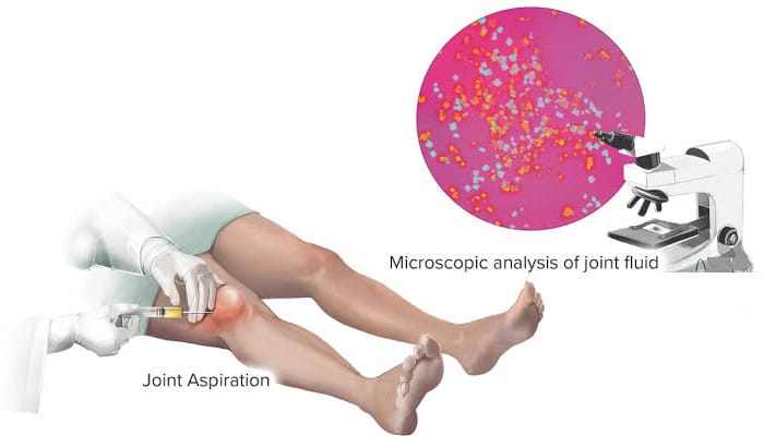 تحليل سائل المفاصل Synovial Fluid Analysis