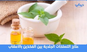 علاج التسلخات الجلدية بين الفخذين بالأعشاب