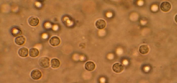 ما معنى pus cells ؟ في تحليل البول .. والأرقام الطبيعية