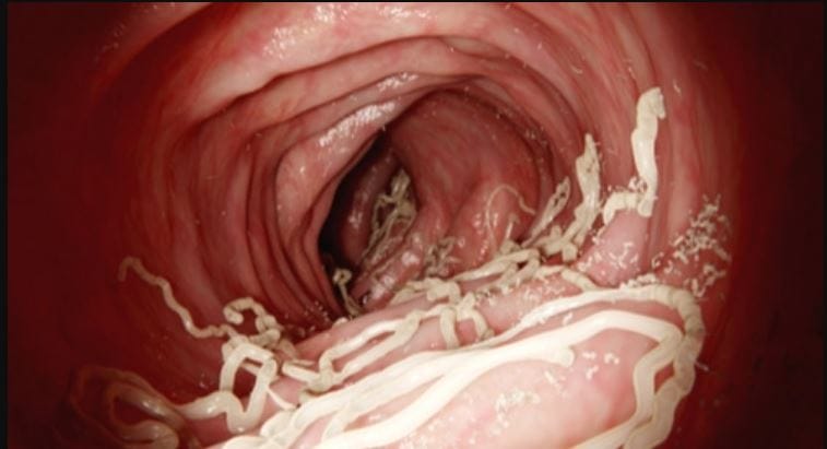 هل ديدان البطن معدية؟