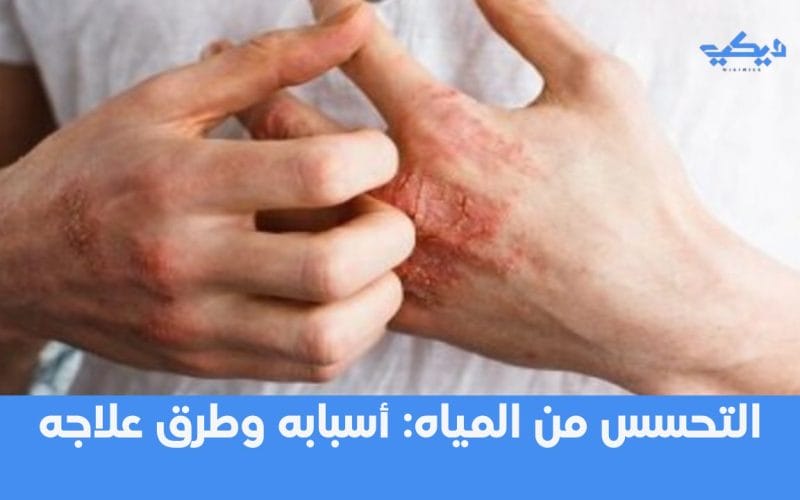 التحسس من المياه: أسبابه وطرق علاجه