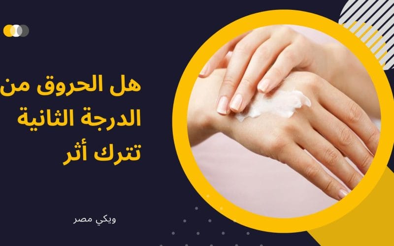 هل الحروق من الدرجة الثانية تترك أثر