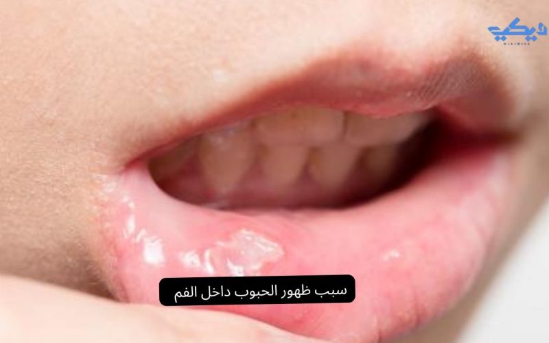 أسباب ظهور الحبوب داخل الفم: ما الذي يخبرنا به جسدنا؟